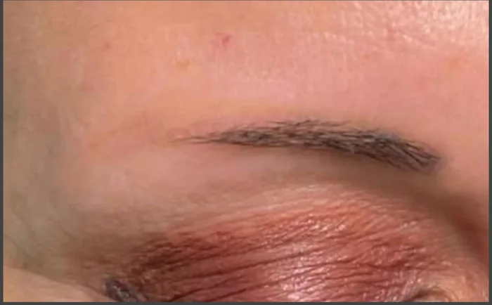 Después - Eliminación de Microblading