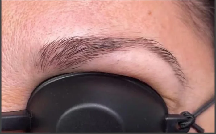 Después - Eliminación de Microblading