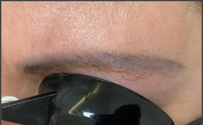 Antes - Eliminación de Microblading