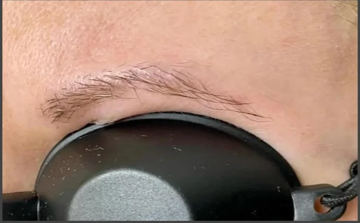 Después - Eliminación de Microblading