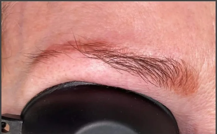 Antes - Eliminación de Microblading