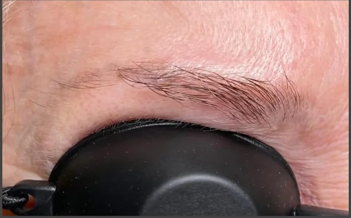 Después - Eliminación de Microblading