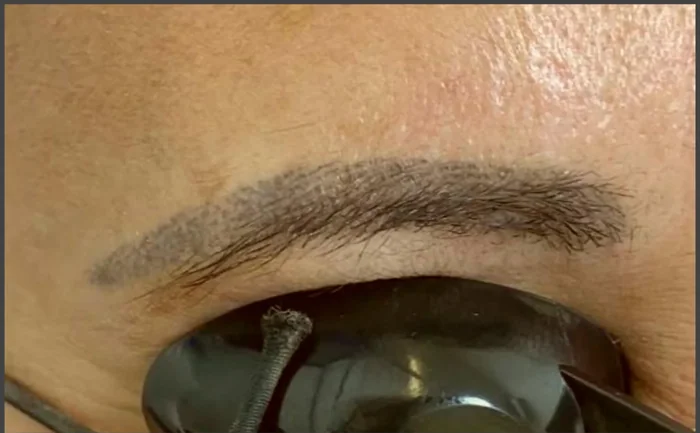 Antes - Eliminación de Microblading