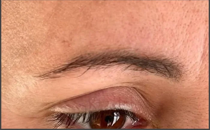 Después - Eliminación de Microblading