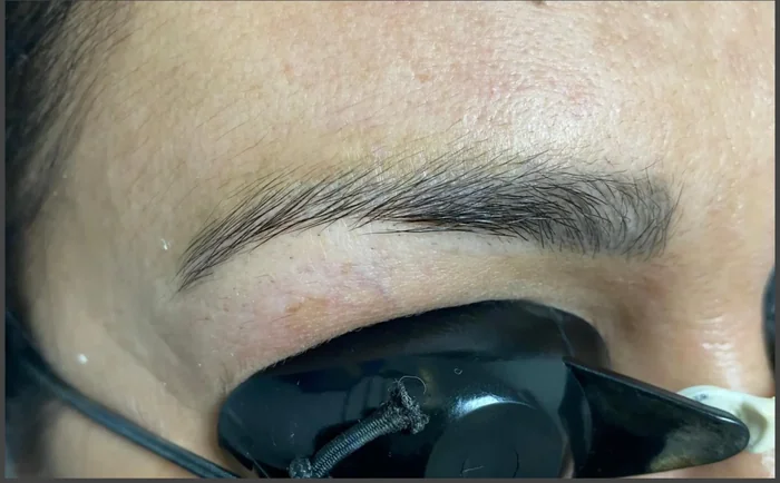 Después - Eliminación de Microblading