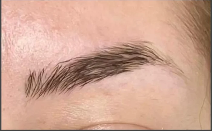 Después - Eliminación de Microblading