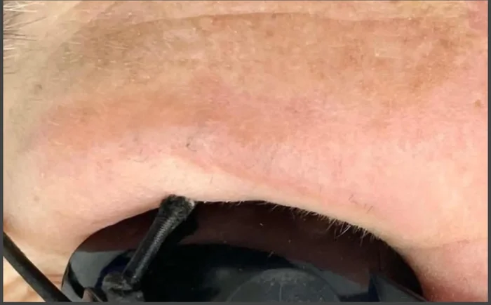 Después - Eliminación de Microblading