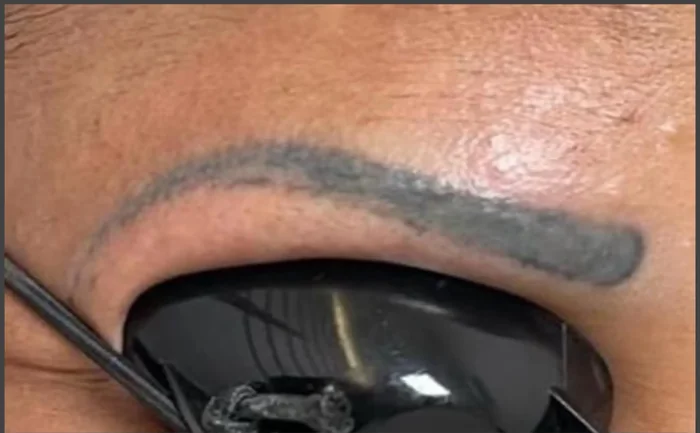 Antes - Eliminación de Microblading