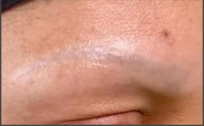 Después - Eliminación de Microblading