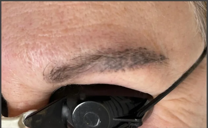 Antes - Eliminación de Microblading