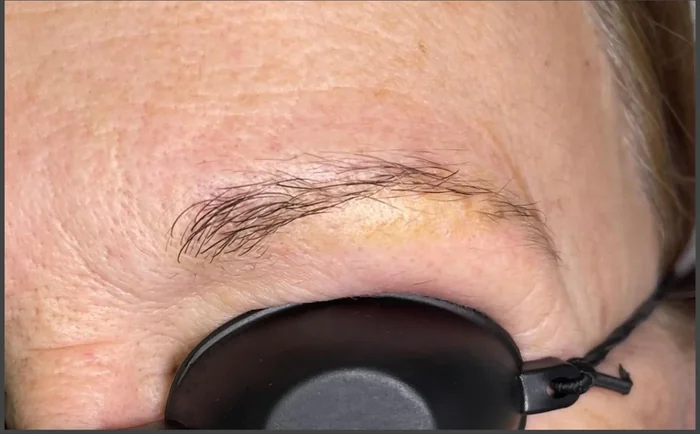 Después - Eliminación de Microblading