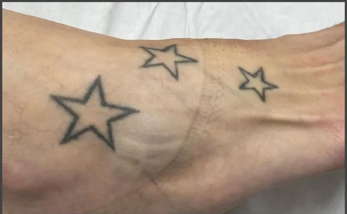 Antes - Eliminación de Tatuajes