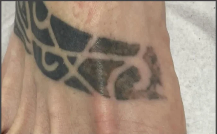 Antes - Eliminación de Tatuajes