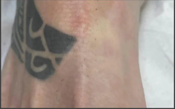 Después - Eliminación de Tatuajes