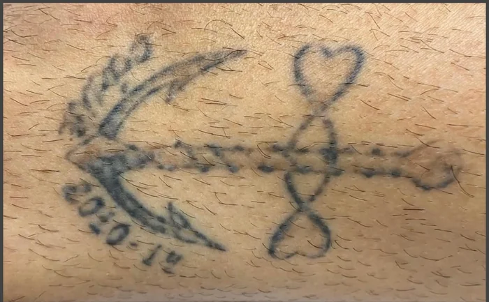 Antes - Eliminación de Tatuajes