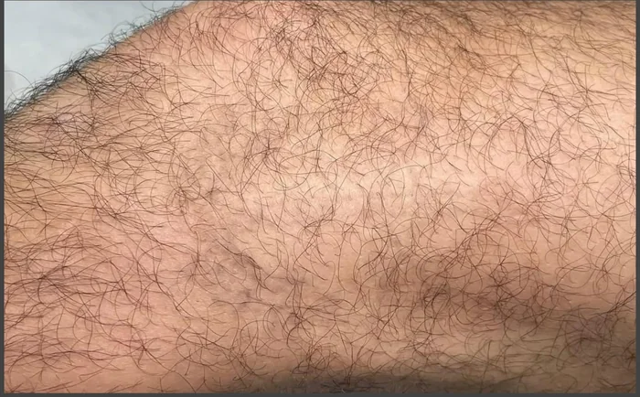Después - Eliminación de Tatuajes