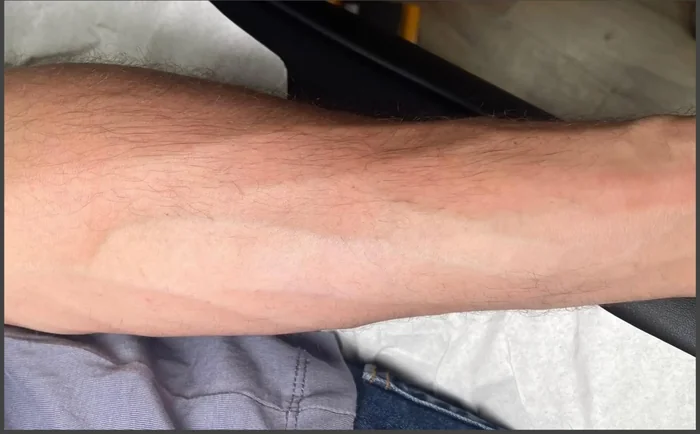 Después - Eliminación de Tatuajes