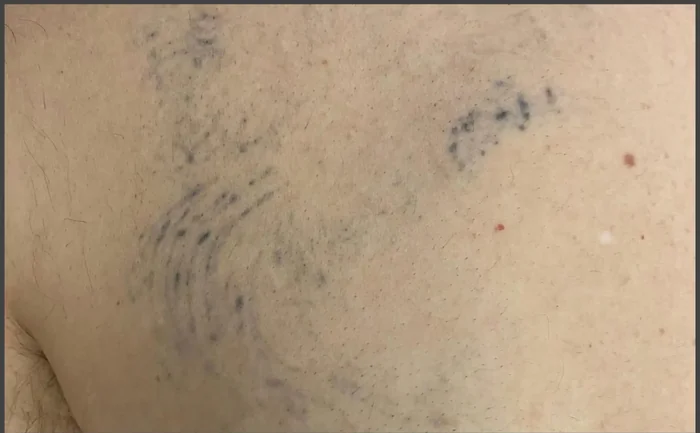Antes - Eliminación de Tatuajes