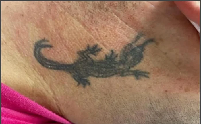 Antes - Eliminación de Tatuajes