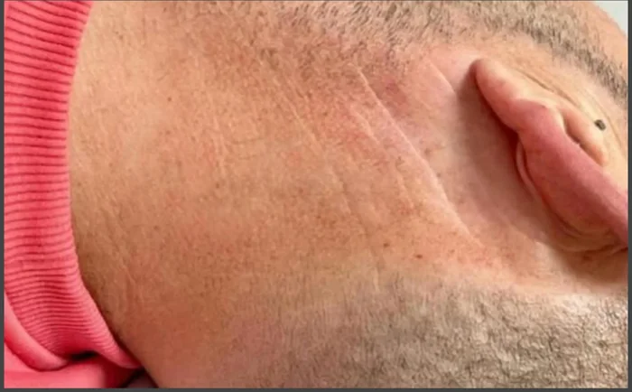 Después - Eliminación de Tatuajes
