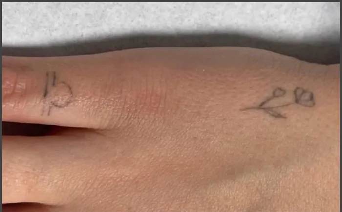 Antes - Eliminación de Tatuajes