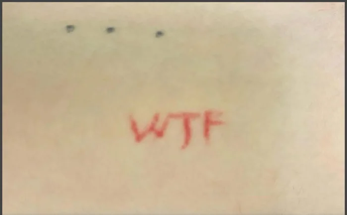 Antes - Eliminación de Tatuajes