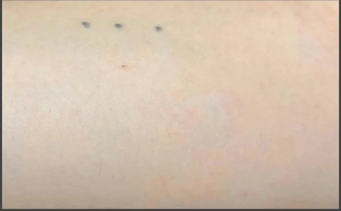 Después - Eliminación de Tatuajes