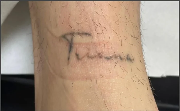 Antes - Eliminación de Tatuajes