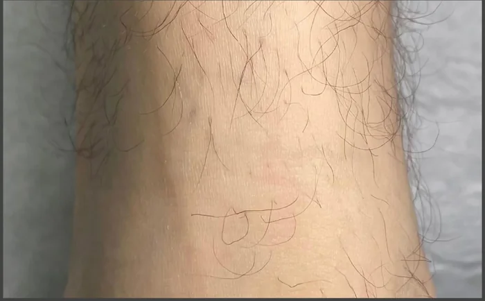 Después - Eliminación de Tatuajes