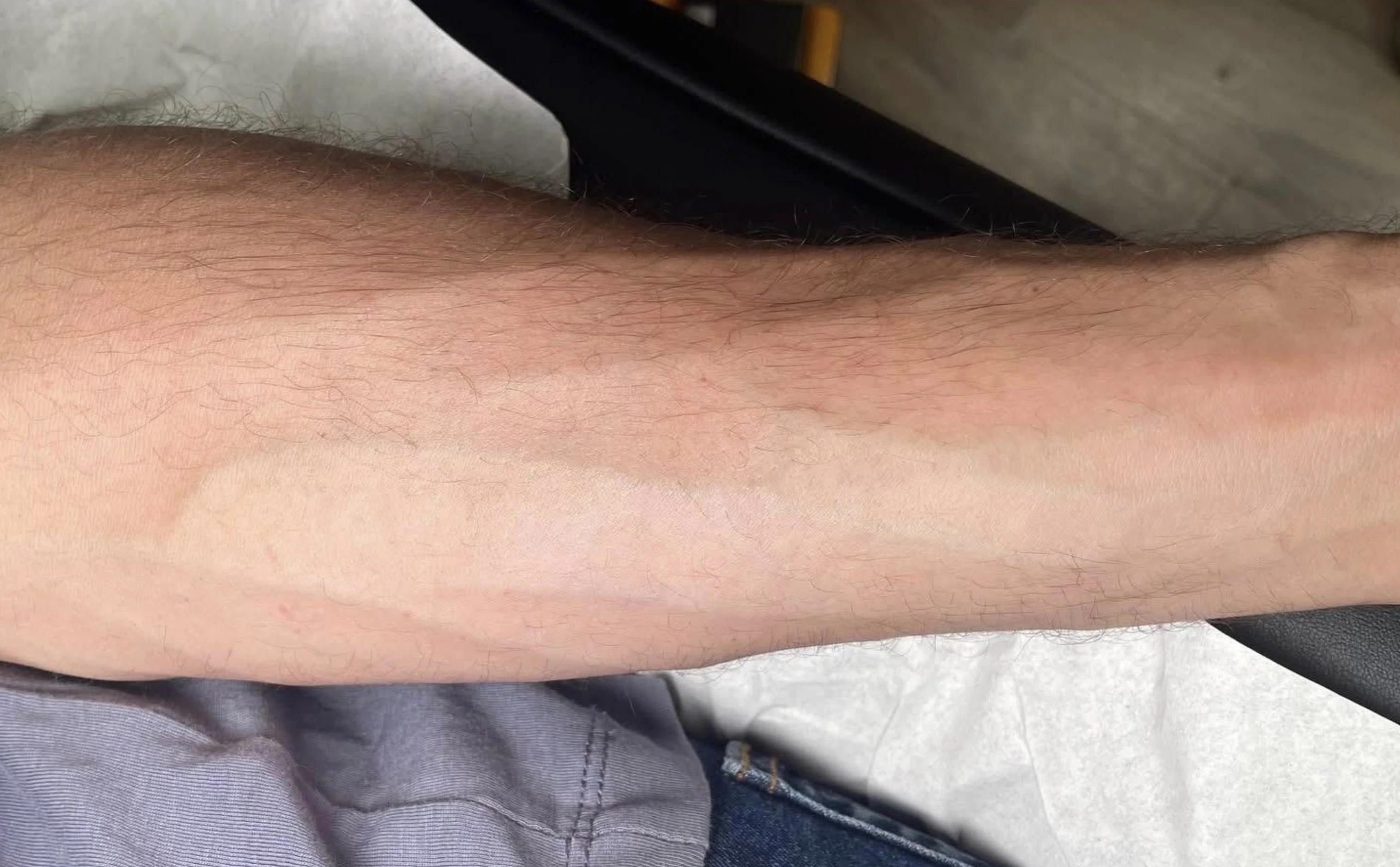 Después - Eliminación de Tatuajes