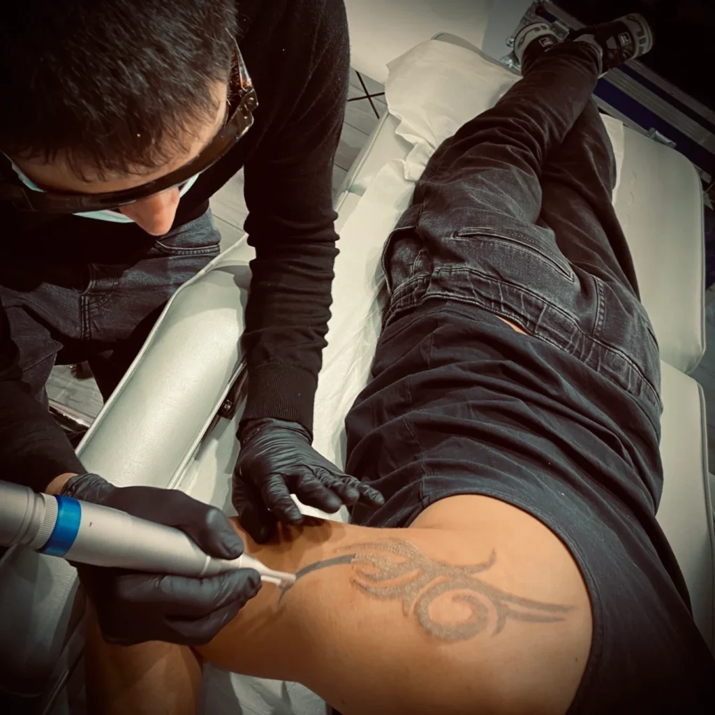 Eliminación de tatuajes en Dos Hermanas